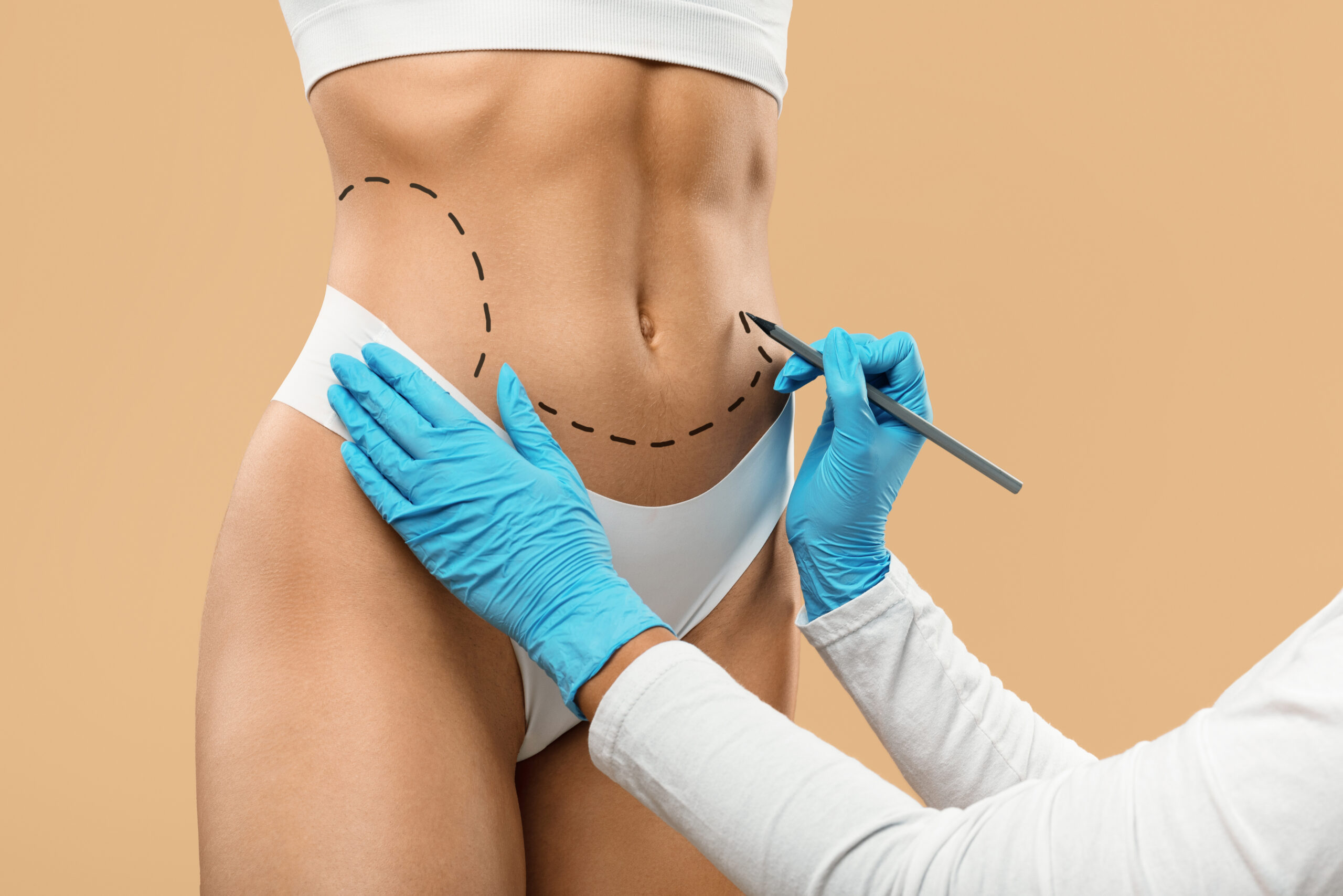 Doctor Drawing Dashed Line Marks On Female Body Before Plastic Surgery Operation, Unrecognizable Young Woman In Underwear Getting Ready For Aesthetic Liposculpting Treatment, Creative Collage